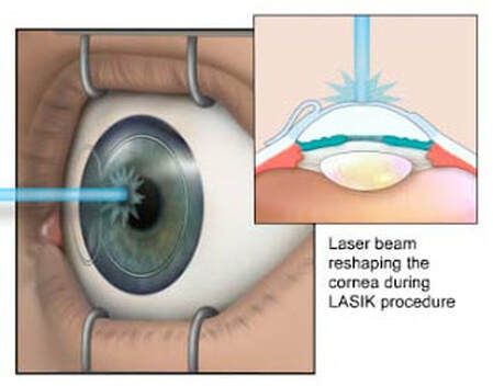 lasik-surgery-laser-beam