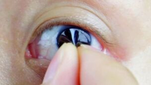 Soft contact lenses. Removing lens from eye